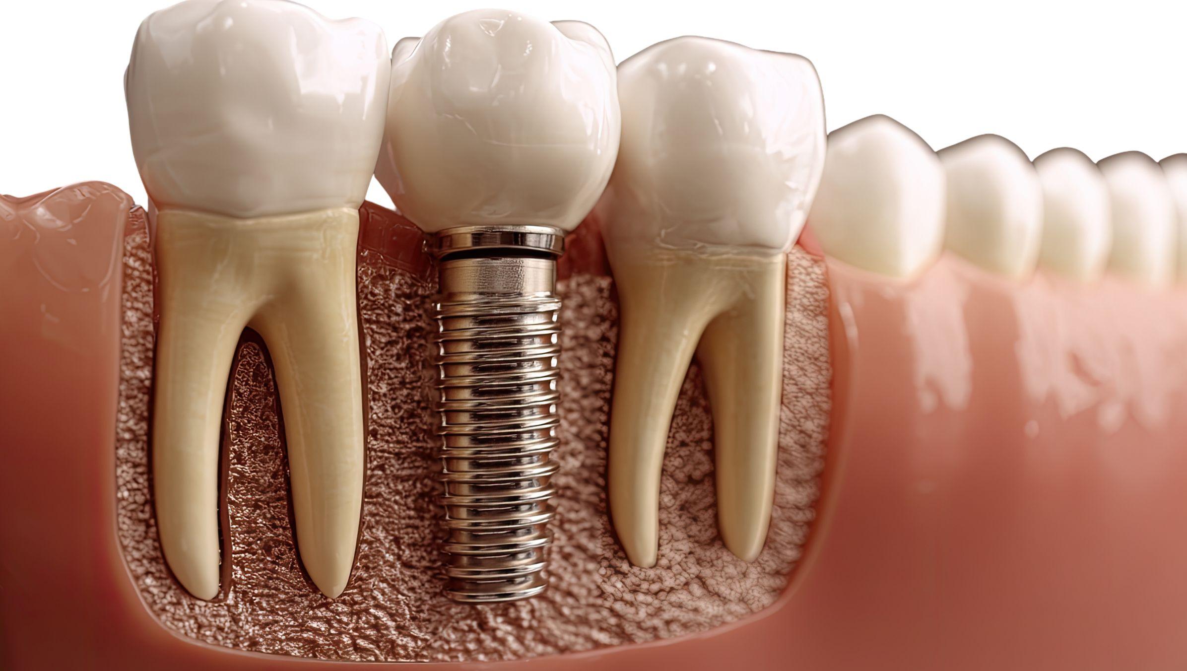 Implantologia Dentale: Cos'è e a Cosa Serve