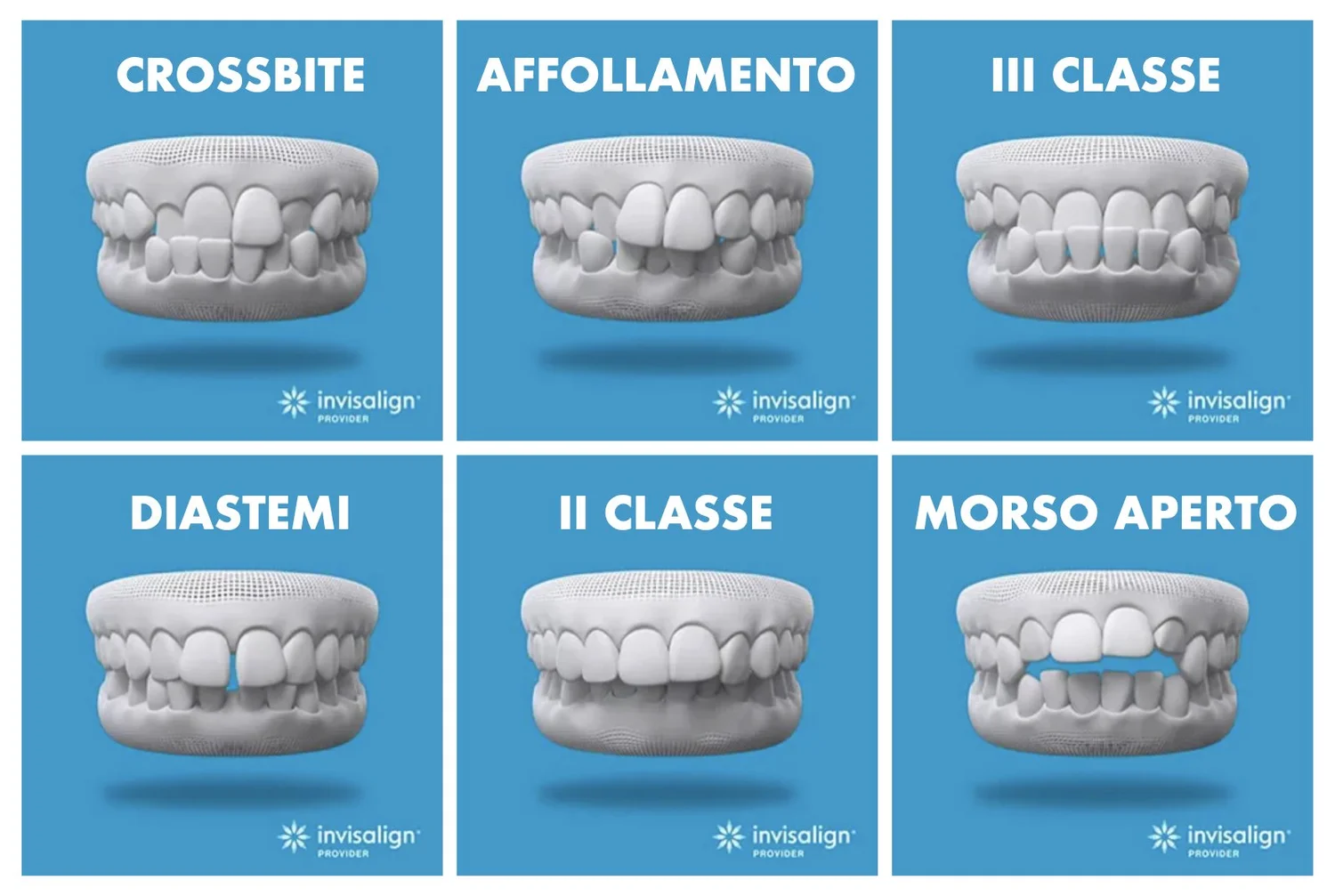Allineatori Invisibili Invisalign: Soluzioni per Problemi Dentali