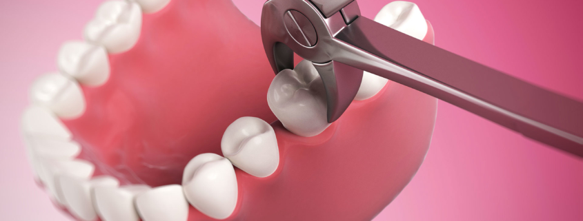 Quando togliere il dente del giudizio: 5 motivi importanti